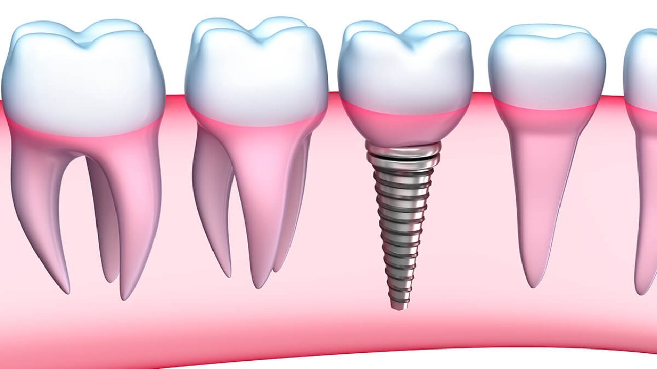 Dental Implant - A Useful Cosmetic Operation To Insure! — woodcreekdds