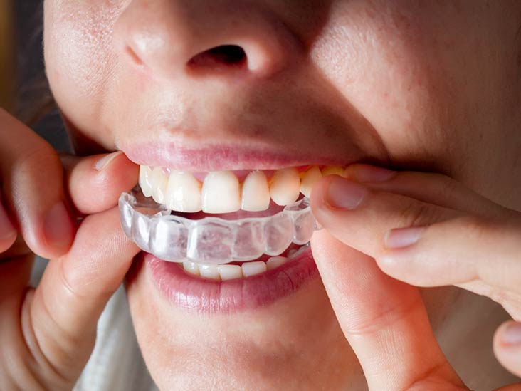 Benefits and disadvantages of Invisalign braces you didn’t know about