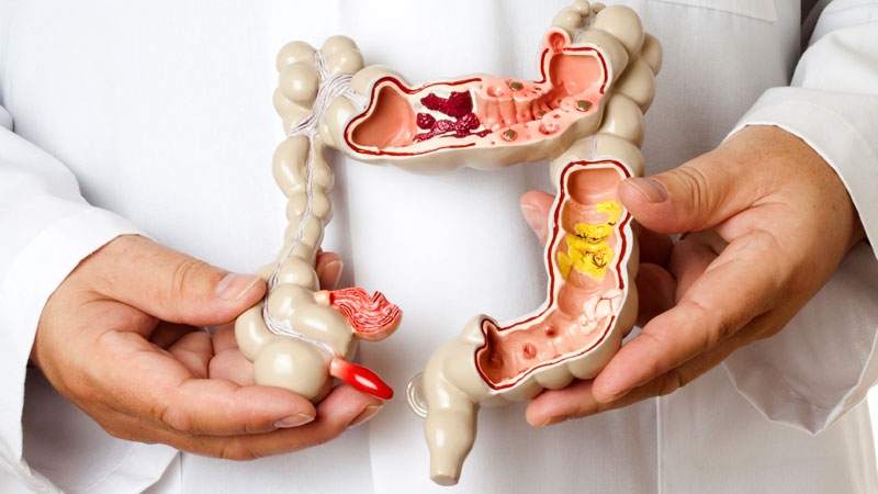 Comprehensive Guide to Irritable Bowel Syndrome (IBS)