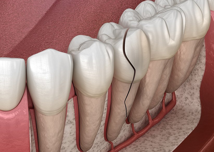 A Dentist's Guide to Diagnosing Tooth Fractures