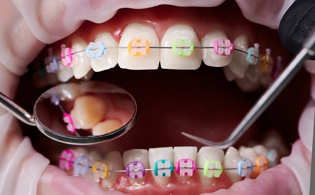 Ceramic Braces | Dr. Lucas Orthodontics | South Florida