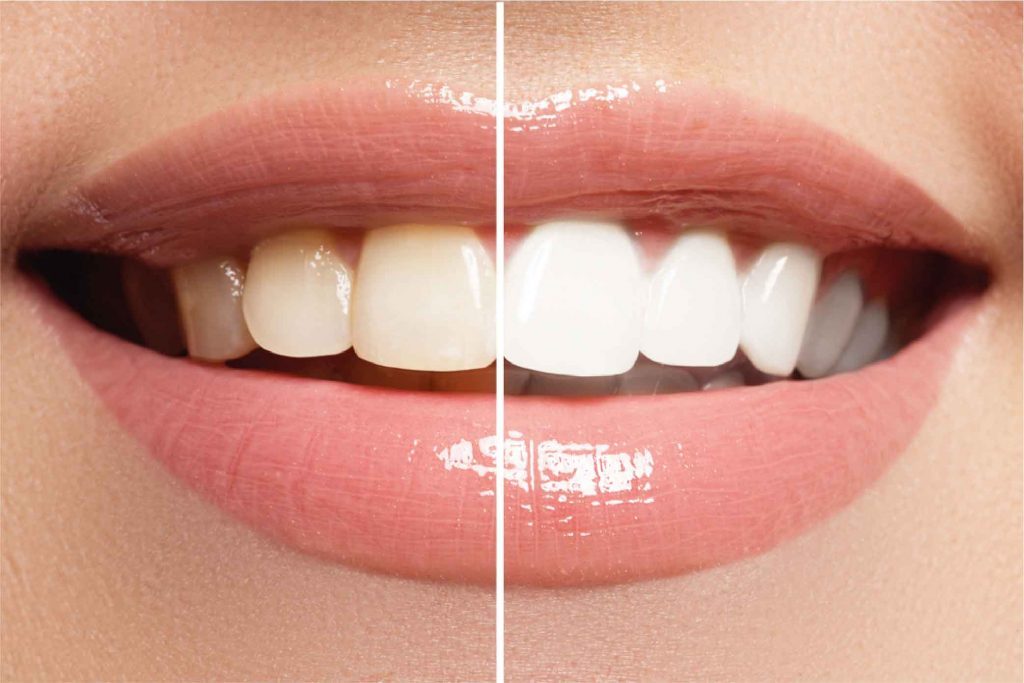 Best Teeth Whitening Abu Dhabi |Teeth Cleaning and Whitening