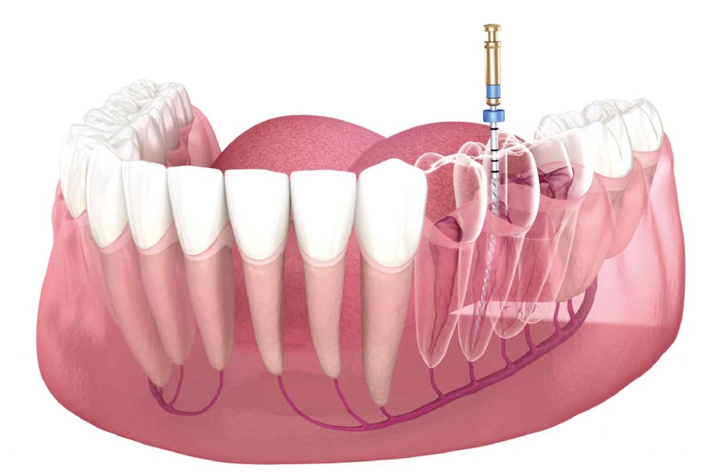 Expert Root Canal Abu Dhabi | Hollywood Smile Medical Center