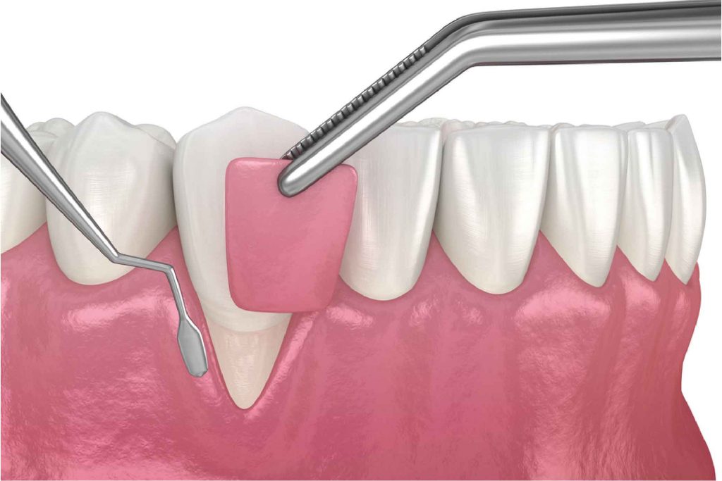 Top Periodontist Abu Dhabi | Hollywood Smile Medical Center