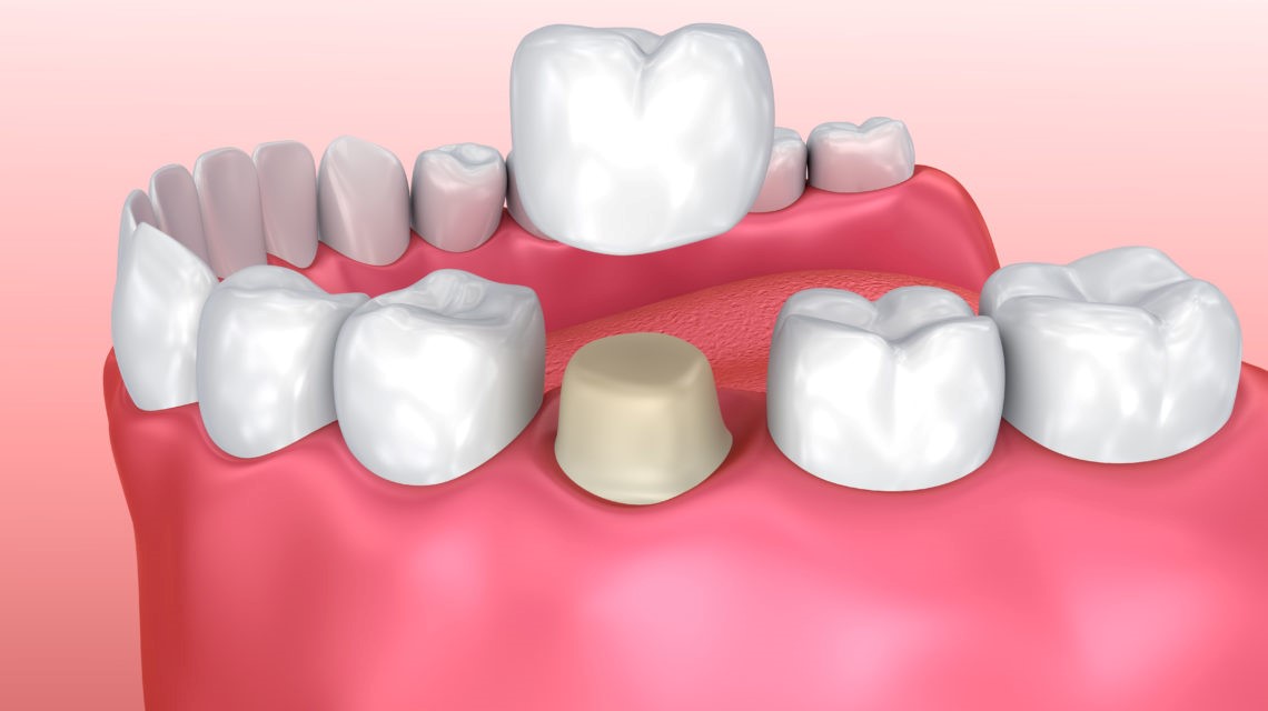 Key Differences Between Temporary and Permanent Dental Crowns