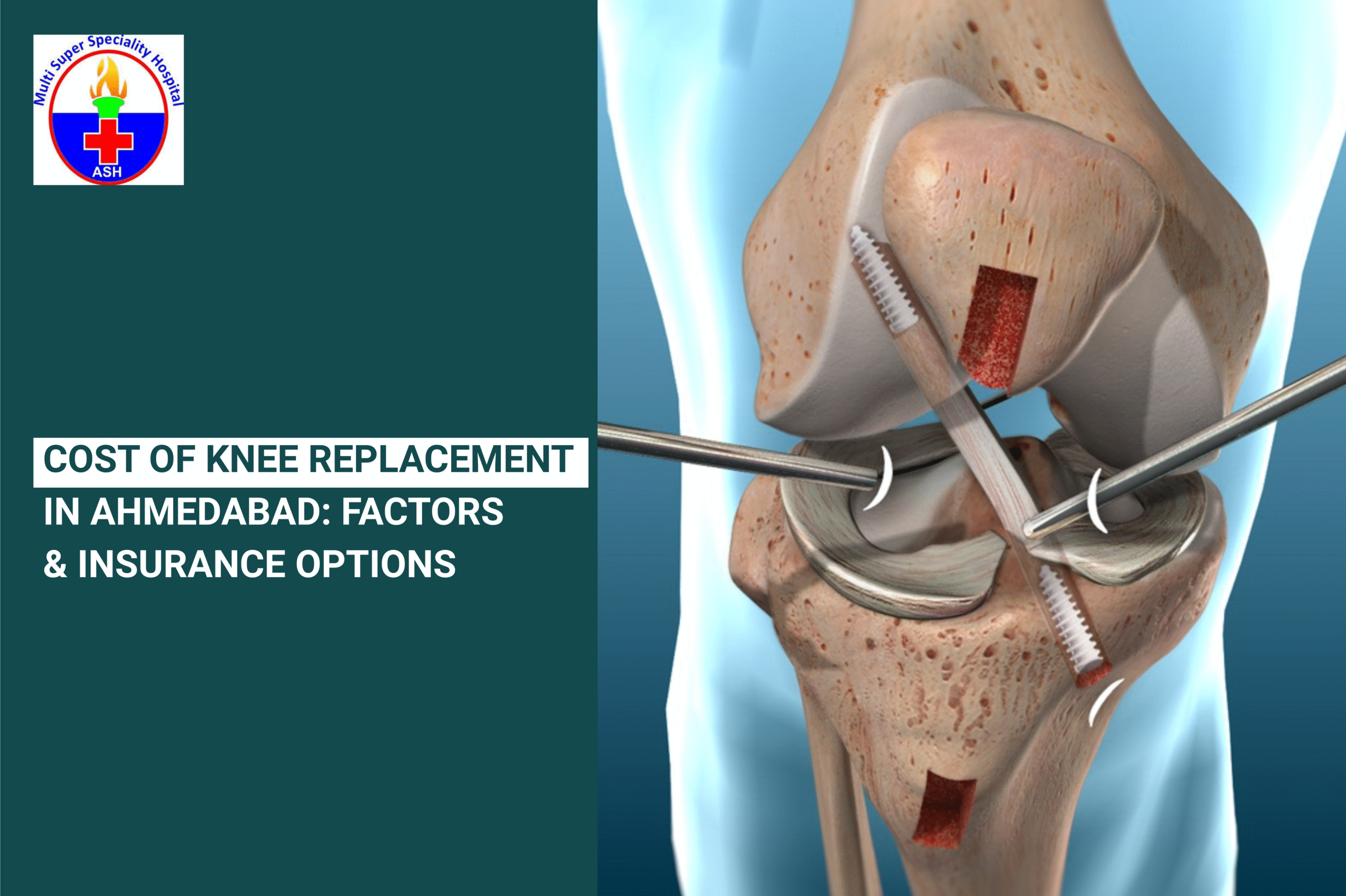 Cost of Knee Replacement in Ahmedabad: Factors & Insurance Options
