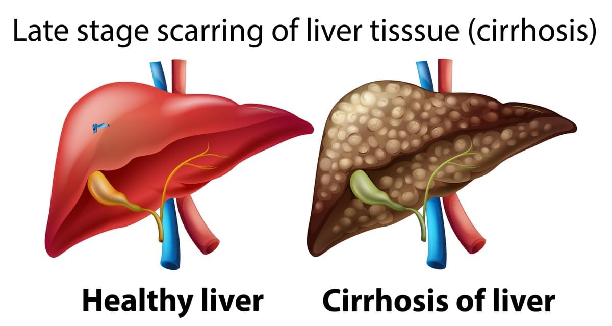Liver Cirrhosis Explained: Early Signs You Shouldn’t Ignore