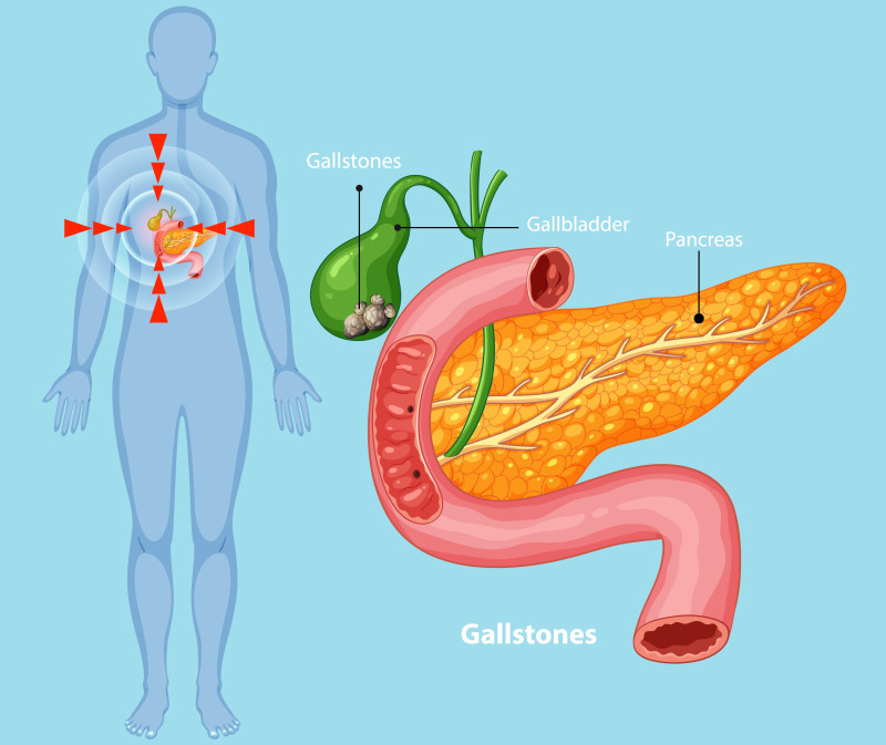 Gallbladder Stones Explained: Diagnosis and Prevention Tips : parthasarthy
