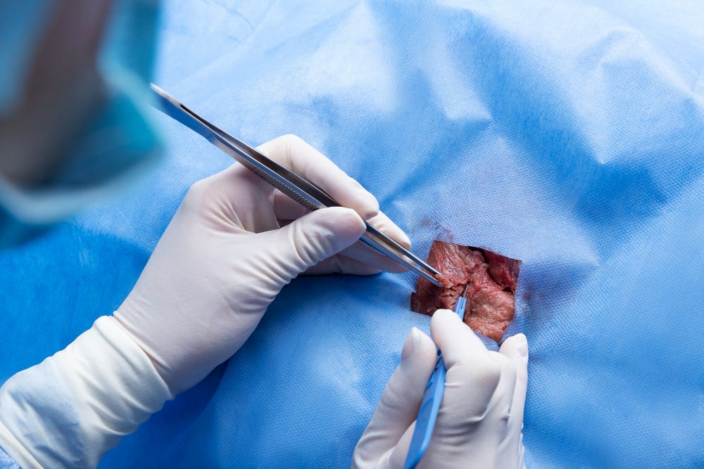 How Laparoscopic Myomectomy Preserves Fertility in Fibroid Patients