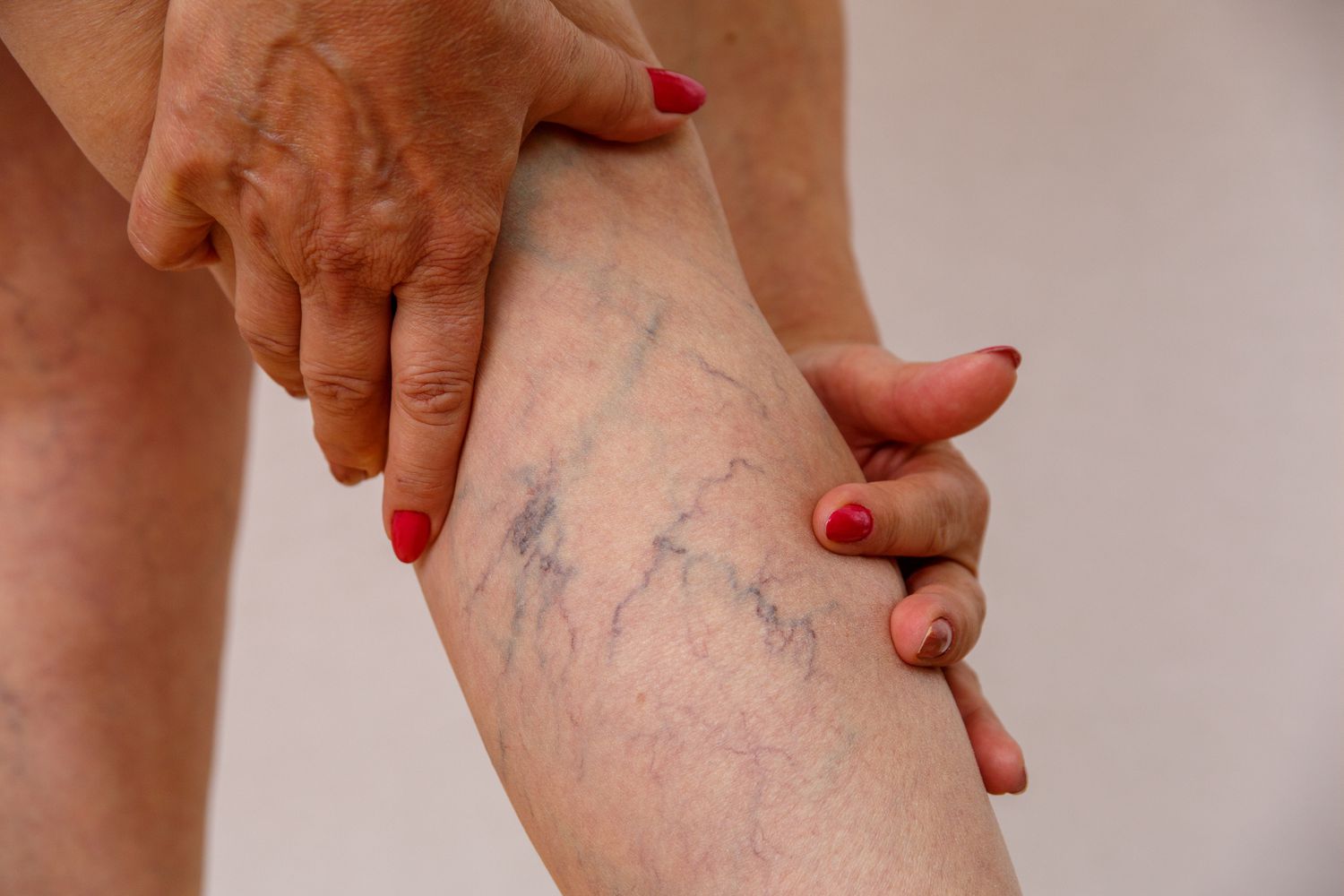 Varicose Vein Treatment Cost in Pune | 100% Advanced Non Surgical Treatment