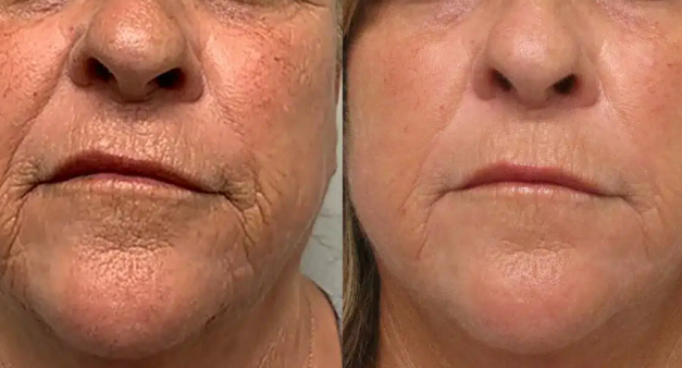 Prepare for Your First Lip Filler Appointment – nebulawellness