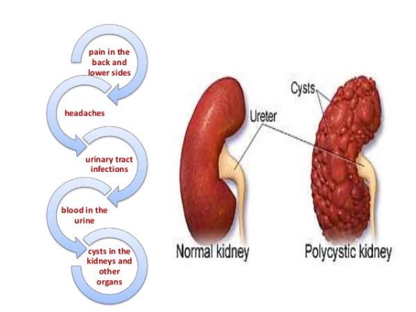 Polycystic Kidney Disease - Enlarged Kidney - Herbal Care Products - Blog