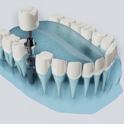 Dental Implant in Islamabad - Tooth Implants in Pakistan