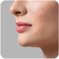 Acne & Acne Scarring Treatment Dandenong, Dandenong South and North