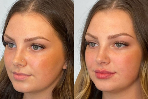 4 Ways Lip Filler in Mississauga Boosts Your Confidence : nebulawellne — LiveJournal