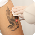 Unwanted Tattoo Removal Dandenong, Laser Tattoo Removal Service