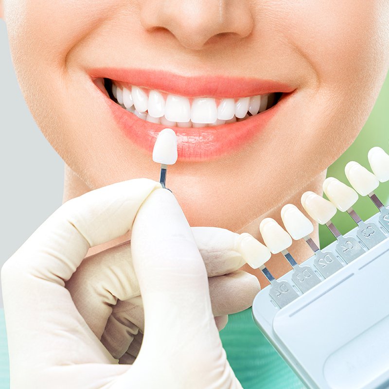 Best Dental Veneers Abu Dhabi | Smile Makeover Experts