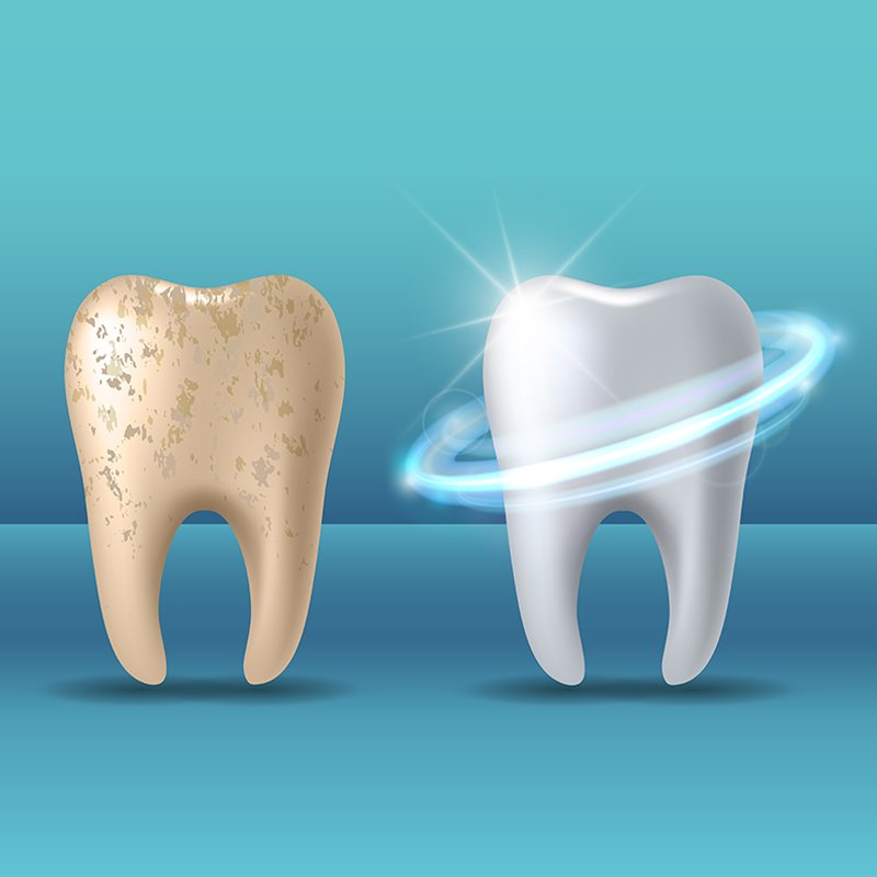 Best Teeth Whitening in Abu Dhabi | Brighten Your Smile