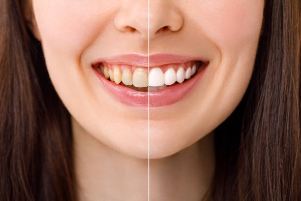 Is Professional Whitening Safe for Sensitive Teeth and Gums? – Biz Buzz Central
