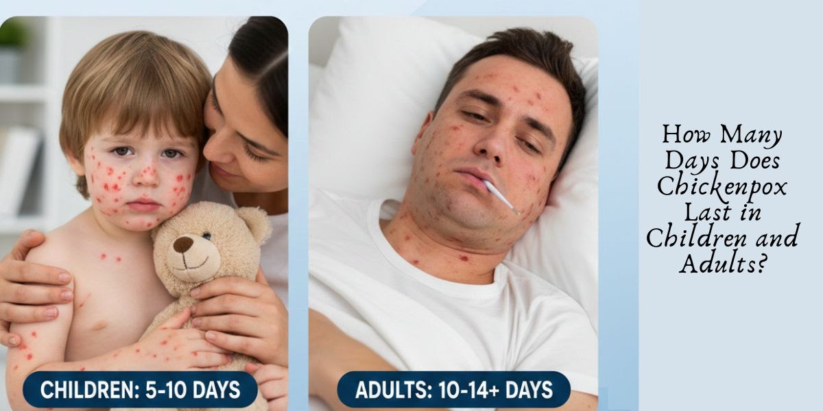 How Many Days Does Chickenpox Last in Children and Adults?