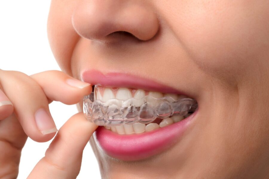 Invisalign Dentistry | Straighten Your Smile in O****ard