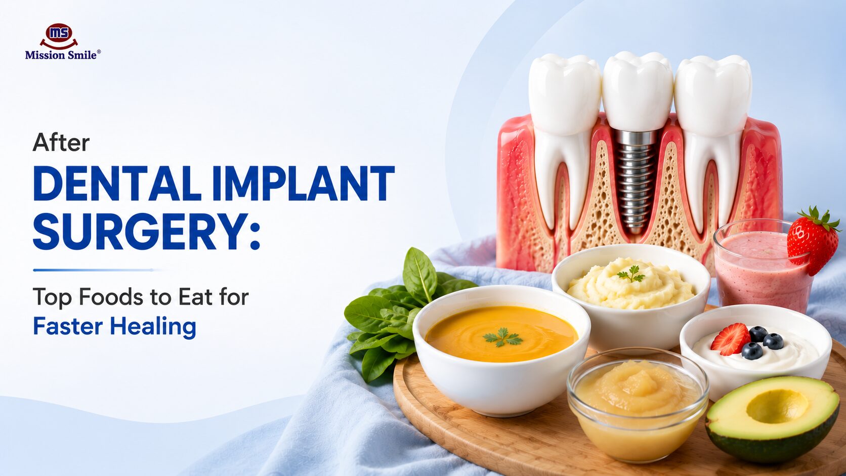After Dental Implant Surgery: Top Foods to Eat for Faster Healing