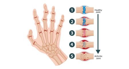 Best Rheumatoid Arthritis Treatment in Gurgaon