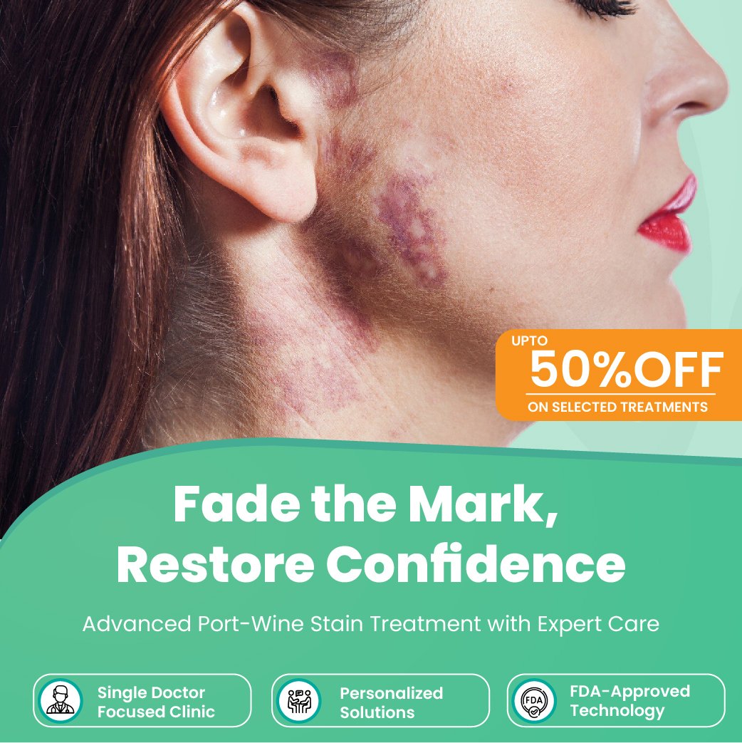 Port Wine Stain Laser Treatment: A Safe and Effective Solution