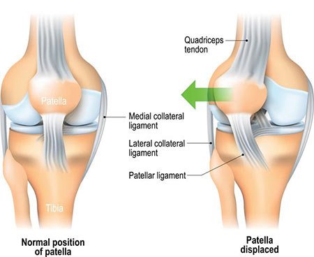 Best Chondromalacia Patella Treatment In Gurgaon