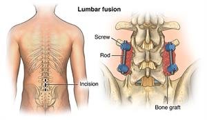 Best Lumbar Spinal Stenosis Treatment In Gurgaon