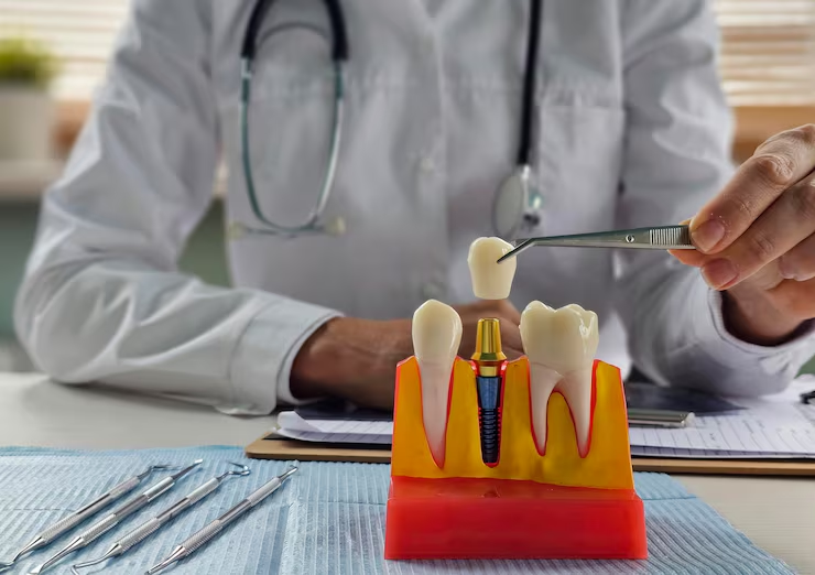 Restore Your Smile with Dental Implants in Simi Valley