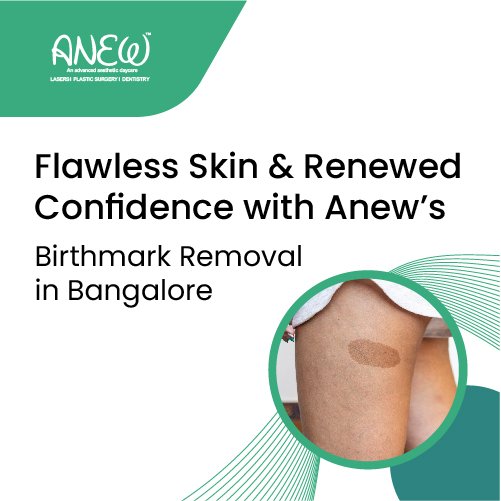 Laser Treatment for Birthmark Removal | Advanced Laser Therapy