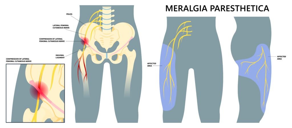 Best Meralgia Paresthetica Treatment In Gurgaon