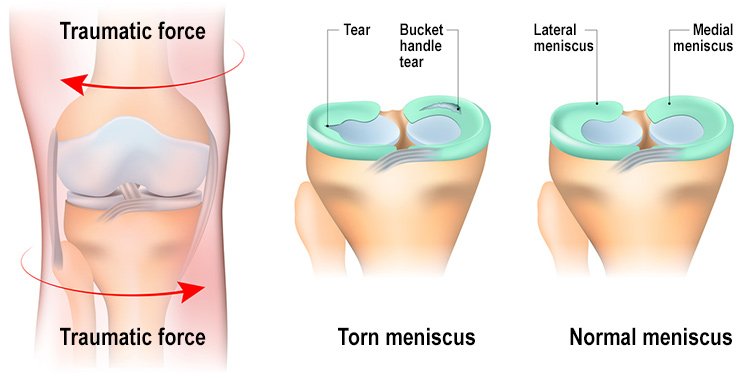 Best Meniscus Injury Treatment In Gurgaon