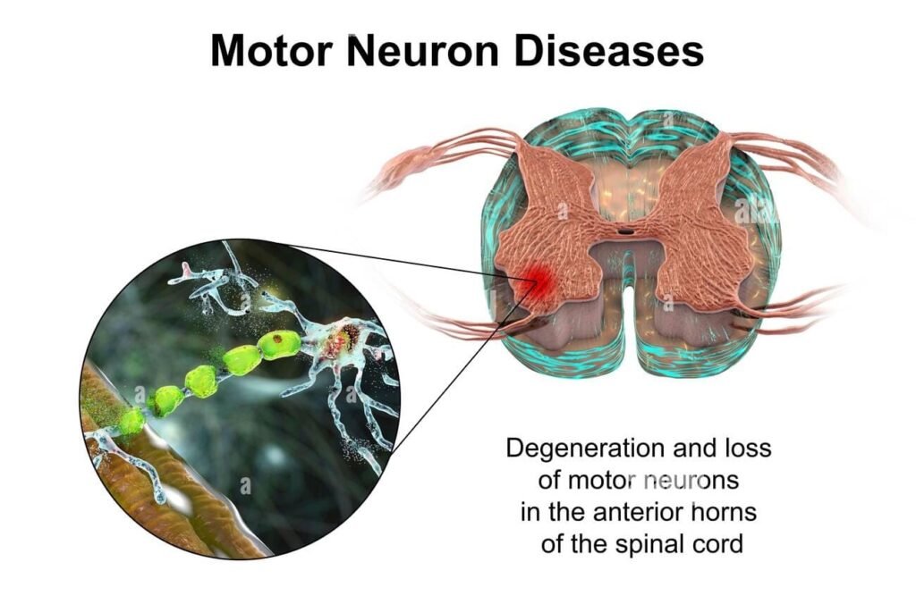 Best Motor Neuron Disease Treatment In Gurgaon
