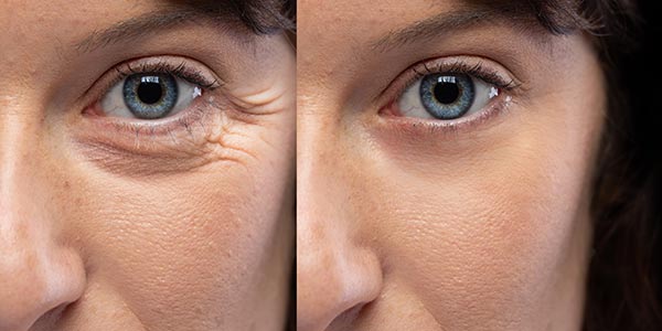Botox Injections and Cosmetic Treatment in Kitchener & Waterloo
