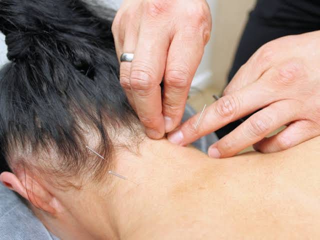 Does Acupuncture Really Work for Neck Pain?