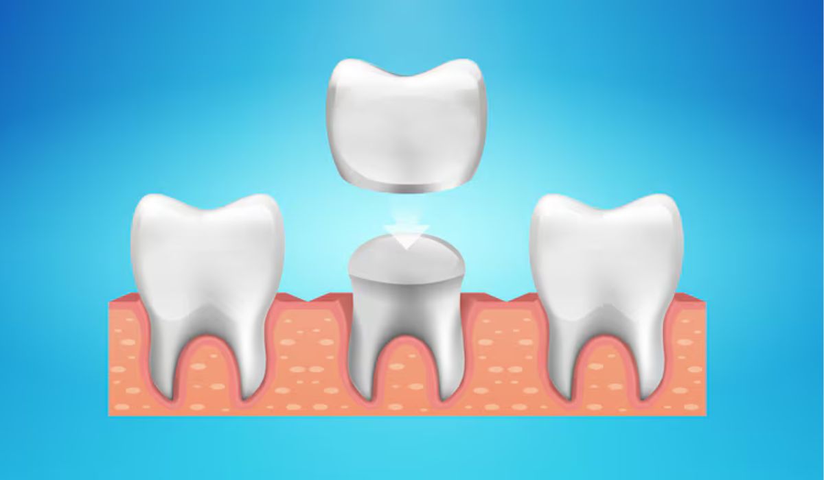 What Is a Temporary Dental Crown & Why You Need One